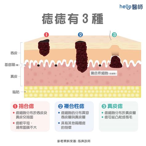 痣的形成原因|痣是什麼？一次了解痣原因、就醫時機以及如何改善